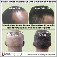 Dr. Sanusi Umar Invents New Hair Restoration Tools for Afro-Textured Hair