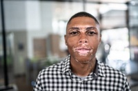 (BPRW) FDA Approves First At-Home Topical Treatment for Vitiligo